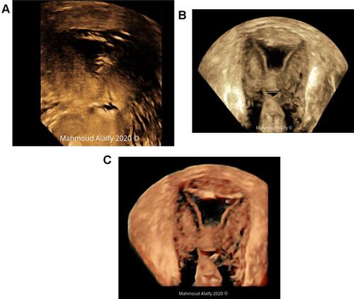 Figure 5 (Aand B) demonstrate 3D SHG rendering image of the uterus showing the cesarean scar niche width in the coronal cut of the 3D volume, Figure 5 C shows 3D SHG with HD live rendering demonstrating the niche width .