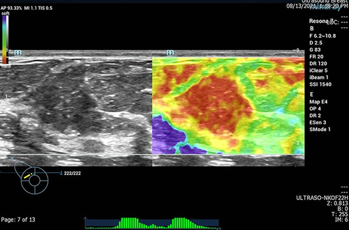 Figure 8 Ultrasound elastography of a 50-year-old woman with invasive ductal carcinoma of the right breast shows that the cancer mass has lower elasticity (red) than the surrounding normal breast tissue (yellow, green, and blue).