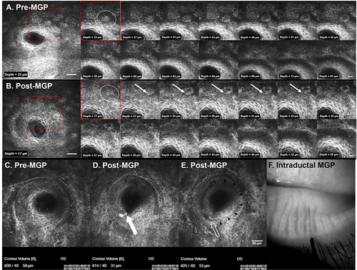 Figure 3 (A and B) Images of progressive volumetric scans of an identical gland pre and post-Meibomian gland probing (MGP) using in vivo confocal microscopy (IVCM). Red outline indicates inlay of larger image. (A) Meibomian gland pre-MGP showing orifice-associated rete ridge epithelial/basement membrane structures (OARREBS) (white circle) in continuity with the basement membrane and basal epithelium of the Meibomian gland. (B) Identical Meibomian gland to (A) post-MGP showing the same OARREBS (white circle) with a single epithelial cell (white arrow) cleaving from the OARREBS and incorporating into the Meibomian gland duct wall epithelial cell layers. The remaining smaller OARREBS is further from the Meibomian gland lumen with subsequent morphologic change into a portion of the basement membrane. Large image scale bar, 50µm; small image scale bar, 20µm. (C–E) IVCM images immediately before and after MGP using a 76μm probe. (C) Meibomian gland immediately pre-MGP. (D and E) Meibomian gland immediately post MGP at a depth of 31μm and 53μm, both showing a notch at the lumen inferiorly. Image (D) demonstrates apparent debridement of terminally differentiated and keratinized epithelium lining the lumen while (E) shows probe path through suprabasal ductal epithelium. Probing procedure is confined to the epithelium compartment, explaining lack of secondary fibrosis. (F) Location and presence of a 4mm length probe (76μm OD) inside the duct of a meibomian gland using infrared video meibography. Note that acinar-ductule units are visible overlying the device. (F) adapted with permissions from Maskin, Steven L., and Sreevardhan Alluri. “Meibography guided intraductal meibomian gland probing using real-time infrared video feed”. British Journal of Ophthalmology 104.12 (2020): 1676–1682.