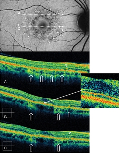 Figure 4 Case 2 fundus autofluorescence and high definition spectral domain optical coherence tomography (HD-OCT). Fundus autofluorescent frame of the right eye (20/20 best corrected visual acuity) shows mottled autofluorescence in the macular area and clearly delineates the retinal flecks. HD-OCT scans (A, B, and C) show an intact inner segment and outer segment interface of the photoreceptors (PR) centrally (enlarged view), but diffuse parafoveal loss of the PR layer (open arrows), and small hyperreflective lesions presented either as dome-shaped deposits within the retinal pigment epithelium (RPE) (B, thin arrow), or as small linear deposits located at the level of the outer nuclear layer and clearly separated from the RPE (A and C, arrowheads).