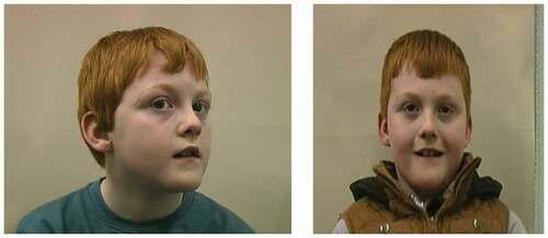 Figure 4. This child with albinism-associated nystagmus and a left head turn (a) underwent a Kestenbaum procedure for correction of his head posture. No head turn is present after the operation (b). Reproduced with permission from Papageorgiou et al. [Citation77]