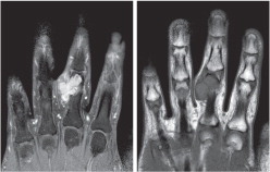 Figure 1. MRI of localized-type TGCT, affecting digits: a 43-year-old male patient with a well-circumscribed tumor in the proximal phalanx of the third digit of the right hand. Left panel: A coronal T1-weighted MRI after intravenous contrast injection. Right panel: A clear coronal T1-weighted MRI without intravenous contrast injection.
