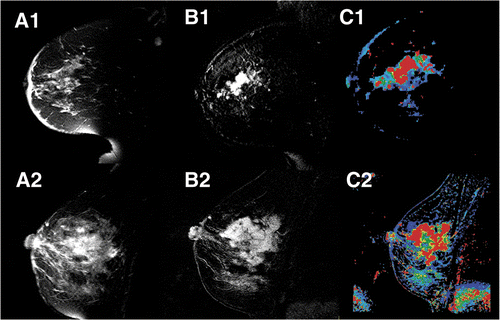 Figure 4. For the same two patients from Figure 3: (A1, A2) fast-spin echo images; (B1, B2) subtraction images between the maximum enhancement time point and baseline; and (C1, C2) WiP maps.