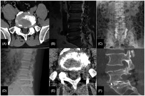 Figure 2. A typical case of MIS-TLIF CTS. Notes: (A) CT shows L4/5 left FLDH. (B) sagittal MRI shows L4/5 FLDH. (C) and (D) X-ray images demonstrate permanent position after 1 year.(E) and (F) coronal CT images after 1 year.