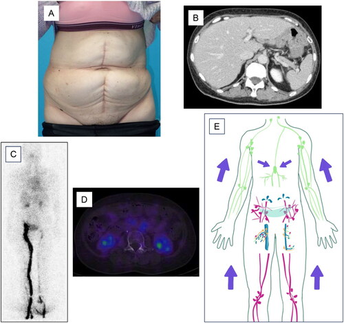 Figure 3. Postoperative findings. Abdominal distension disappears after LVA (A). Contrast-enhanced CT shows no evidence of ascites effusion (B). Lymphoscintigraphy (C) or SPECT (D) shows no evidence of radioisotope leakage into the peritoneal cavity. No secondary lymphedema is observed in either lower extremity. However, there is delayed lymphatic flow in the left lower extremity. The schema indicates that LVA reduced the amount of lymphatic fluid leaking into the abdominal cavity (E).