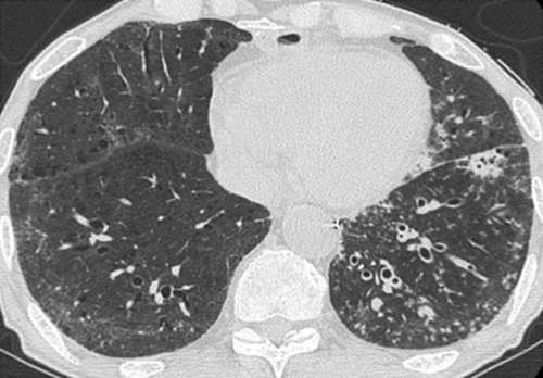 Figure 4. HRCT scans after treatment with prednisone show disappearance of broad ground glass opacity seen in the previous chest CT scan.