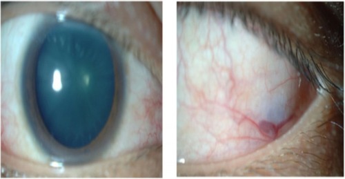 Figure 1 Appearances of Case 1 who was diagnosed with episcleritis.