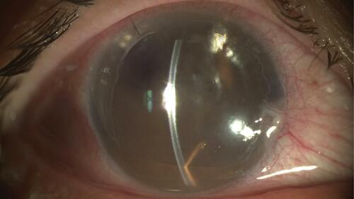 Figure 3 Pupillary block caused by the air bubble.