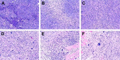 Figure 8 Pathological picture (×200) of tumor tissues by H&E staining in S180-bearing mice after treating with saline (A), CPT-11 injection (15.88 mg/kg) (B), CPT-11 injection (15.88 mg/kg) (C), SN38-PA liposome (8.03 mg/kg) (D), SN38-PA liposome (16.06 mg/kg) (E), SN38-PA liposome (32.12 mg/kg) (F).