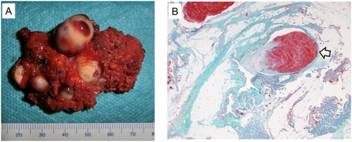 Figure 2. Excised specimen. (A) Macroscopic findings of the resected specimen are shown. Grossly, the parotid lesion is 54 mm in maximum diameter with multiple white stone-like objects. The largest object is 18 mm in size. (B) Elastic-Masson trichrome staining reveals nodular, irregular smooth muscle growth and disconnected elastic fibers in the abnormal vascular wall. Phleboliths (white arrow) are observed in the vascular lumen.