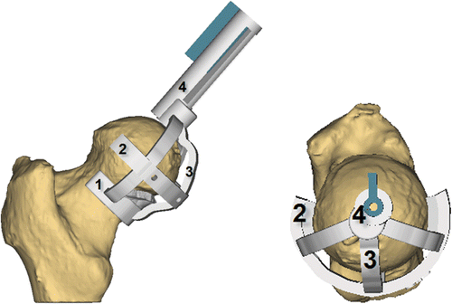 Figure 2. Guide resulting from the guide development study. The components are as follows: 1 – neck collar; 2 – knife collar; 3 – connecting arms; 4 – drill cylinder. (Image created using 3-matic®.)