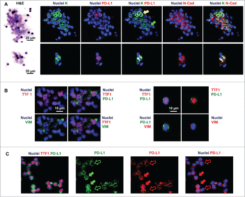 Figure 1. In representative images, nuclei are displayed in blue. Pseudo-colors were changed for each of the four channels to optimize the visualization of the different signals. (Panel A) Phenotype of circulating tumor cells (CTCs) in filters obtained by ScreenCell Cyto kit. Hematoxylin and eosin (H&E) stains and immunofluorescence for wide spectrum screening cytokeratin (K), PD-L1, and N-Cadherin (N-Cad). Large (upper) or small (lower) clusters of K+ cells are shown. Subpopulations of K+ cells co-expressing PD-L1 and N-Cad (yellow arrow) and lacking PD-L1 expression (green arrow) are displayed. (Panel B) Immunofluorescence for thyroid transcription factor 1 (TTF1), PD-L1, and Vimentin (VIM) in filters. Clusters of TTF1+ cells (A) and single TTF1+ cells co-expressing PD-L1 and Vimentin. (Panel C) Immunofluorescence for thyroid transcription factor 1 (TTF1) and PD-L1. PD-L1 expression at cytoplasmic/membranous level (empty arrows) and at nuclear level (full arrows) in TTF1+ cells.