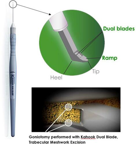 Figure 1 The Kahook Dual Blade. Its tip features a ramp with two parallel blades to engage and excise a strip of trabecular meshwork as it is advanced along the circumference of the iridocorneal angle.