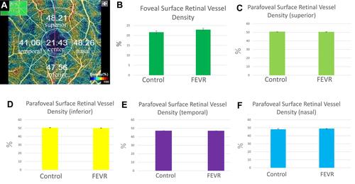 Figure 4 (A) The foveal and parafoveal SRVD maps. (B) The mean foveal SRVD does not differ significantly between the two groups. (C) No significant difference is seen between the two groups in the superior parafoveal SRVD. (D) No significant difference is seen between the two groups in the inferior parafoveal SRVD. (E) No significant difference is seen between the two groups in the temporal parafoveal SRVD. (F) No significant difference is seen between the two groups in the nasal parafoveal SRVD.