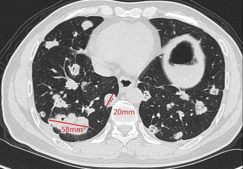 Figure 2. Chest CT in Feb 2019 (3 months after fruquintinib)