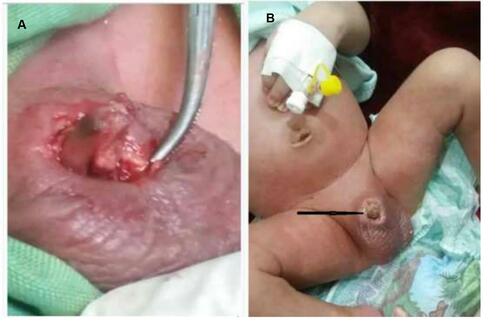 Figure 1 (A) Complete skin loss in the whole penis extended to the scrotum associated with purulent discharge around the penis and distal penile amputation. (B) The distal part of the penis was amputated (arrow).