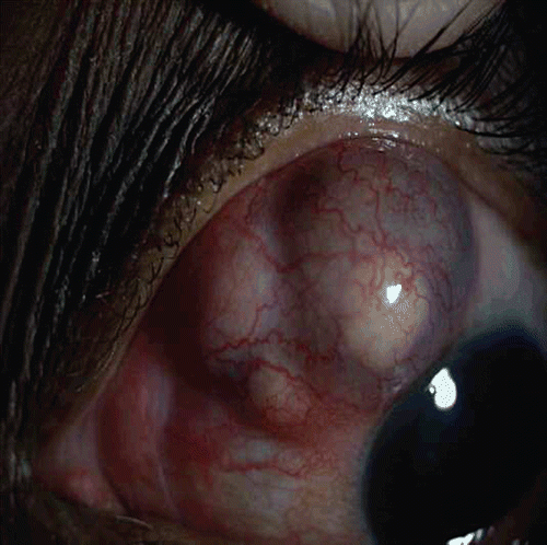 FIGURE 1  Slit-lamp photograph showing multiple nodules in the sclera.