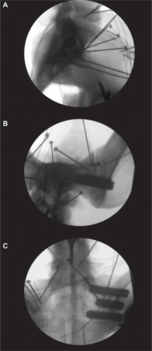 Figure 2 Representative fluoroscopic images showing placement of the three 7.0 mm implants placed in the (A) lateral, (B) inlet, and (C) outlet views.