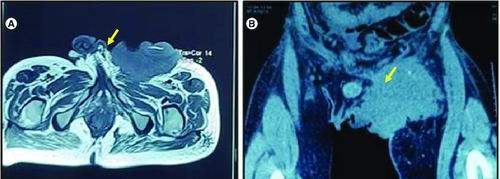 Figure 3. Radiological appearance of the tumor.(A) MRI: Axial T2-weighted section centered on the pelvic region: large left inguinal mass in T2 hypoposignal (yellow arrow). (B) CT scan of the tumor coronal reconstruction without injection of contrast medium: left inguinal mass spontaneously hypodense (yellow arrow).