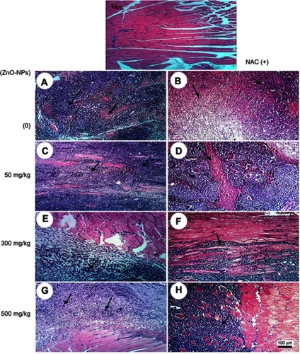 Figure 3 Representative photomicrographs of thigh skeletal muscle tissues of ESC mice treated with different doses of ZnO-NPs (50, 300 and 500 mg/kg) with and without NAC (100 mg/kg) pretreatment. Normal muscle group (NML), (A) ESC group showing necrosis of muscles and masses of chromatophilic tumor cells between the necrotic muscles, (B) ESC+NAC group showing necrosis of chromatophilic tumor cells surrounded by granulation tissue, (C) ESC+50 ZnO-NPs group showing masses of chromatophilic tumor cells between the necrotic muscles, (D) ESC+50 ZnO-NPs+NAC group showing masses of necrotic tumor cells in between necrotic muscle bundles, (E) ESC+300 ZnO-NPs group showing masses of necrotic tumor cells. (F) ESC+300 ZnO-NPs+NAC group showing masses of tumor cells in between muscle bundles, (G) ESC+500 ZnO-NPs group showing masses of chromatophilic tumor cells and giant cells. (H) ESC+500 ZnO-NPs group showing masses of necrotic tumor cells in between muscle bundles (H and E × 100).