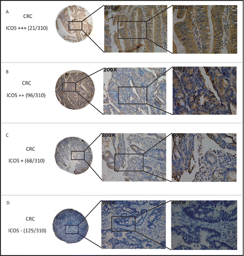 Figure 1. Immunohistochemical staining of ICOS in colorectal cancer. Tumor cores of CRC samples were stained with an ICOS specific monoclonal antibody (clone SP98) by immunohistochemistry. Representative images of ICOS+++ (A), ICOS++ (B), ICOS+ (C) and ICOS-(D).