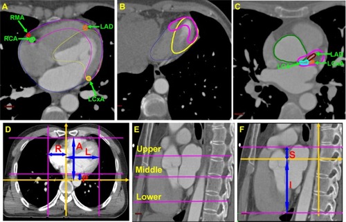 Figure 1 Definitions of cardiac sub-structures and coronary arteries.