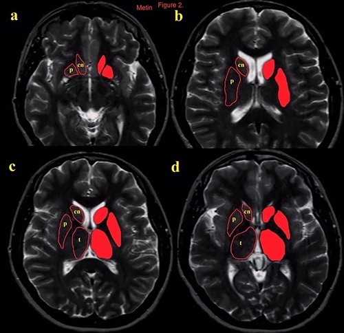 Figure 2. The measurment of striatum and thalamus (a–d) in sequential axial T2 images.