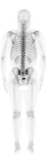 Figure 7 A 99mTc-MDP bone scan revealed that the bone metastases were absorbed.