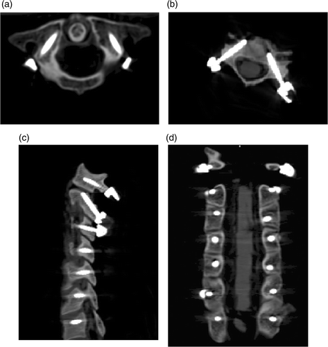 Figure 6. Postoperative CT scan showing good positioning of the cervical pedicle screw. (a) C2 pedicle screw – axial view. (b) C4 pedicle screw – axial view. (c) Sagittal view of cervical pedicle screw. (d) Coronal view of cervical pedicle screw.