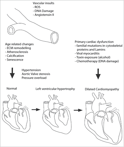 Figure 2. Etiology of Cardiomyopathy onset and progression. DCM is caused in primary and secondary fashion. In secondary it is due to excessive remodelling of the myocardium because of sustained pressure overload caused by vascular remodelling leading to increased overall blood pressure or aortic valve stenosis (hardening). This usually occurs via an intermediate step in which the heart tissue becomes thicker, known as hypertrophy. Primary DCM is caused predominantly by mutations in proteins of the sarcomere, cytoskeleton, or those involved in Ca2+ handling. Additionally, viruses and toxins such as alcohol or chemotherapy agents can initiate DCM independent of vascular remodelling. In this context hypertrophy is bypassed.