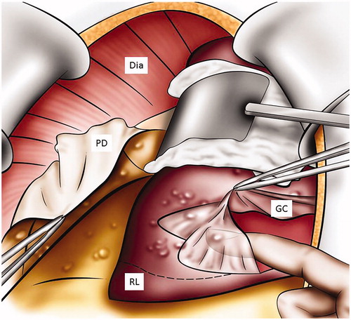 Figure 3. Digital glissonectomy to remove liver surface involvement. This figure illustrates how to expose the peritoneum of the diaphragm and the liver right lobe. A digital peritonectomy of the Glisson capsule is performed. Dia: diaphragm; RL: liver right lobe; GC: Glisson’s capsule; PD: peritonectomy of the diaphragm.