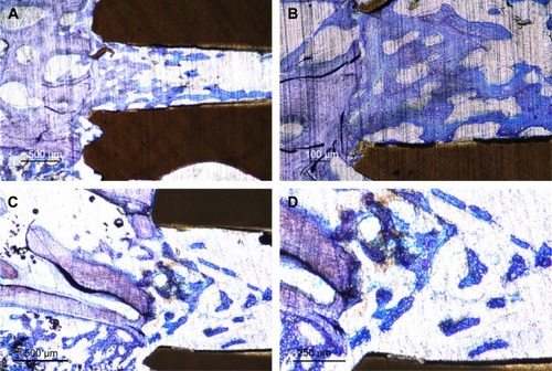 Figure 7 Histological sections in two magnifications showing the apical perforation of HA-coated (A and B) and uncoated (C and D) PEEK implants, 3 weeks after insertion.Notes: The HA-coated implant in lower magnification (A) shows bone growth through the entire hole. In the enlarged image (B), the line between the new bone and old bone can be tracked, and inside the hole, the bone approaches the implant surface with regular intervals through the hole. The uncoated PEEK implant demonstrates significantly less bone area at the entrance and inside the perforated hole compared to that of HA-coated PEEK (C). With the higher magnification, the bone structure was found to be located in the center of the perforation without having contact to the implant surface (D).Abbreviations: HA, hydroxyapatite; PEEK, polyether ether ketone.