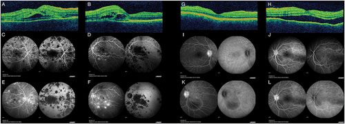 Figure 1. A-B: OCT showing bilateral (A: right eye; B: left eye) bacillary detachments with foveal involvement. C-F: Fluorescein angiography (left) and indocyanine green angiography (right) of both eyes (C&E: right eye; D&F: left eye) disclosing early (C-D) hypofluorescent lesions that become hyperfluorescent in the late frames (E-F) in fluorescein angiography, with persistent hypofluorescent lesions along the angiographic time in the indocyanine green angiography, suggestive of acute posterior multifocal placoid pigment epiteliopathy (APMPPE). G-H: OCT showing bilateral (G: right eye; H: left eye) choroidal folds with a shroud retinal detachment in the left eye. I-L: Fluorescein angiography (left) and indocyanine green angiography (right) of both eyes (I&K: right eye; J&L: left eye) disclosing bilateral optic nerve leakage and pin point pattern with filling of the serous retinal detachments in the fluorescein angiography. The indocyanine green angiography shows shadowing of the serous detachments and subtle scatter hypofluorescent lesions. The angiography findings suggest a diagnosis of Vogt-Koyanagui-Harada syndrome.