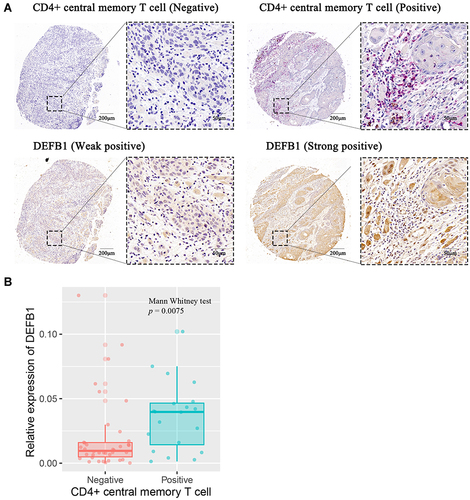 Figure 5 The correlation between protein expression level of DEFB1 and infiltrating CD4+ central memory T cells in oral squamous cell carcinoma (OSCC) tissues. (A) Representative images of both high/low expression of DEFB1 and CD4+ central memory T cell at the same location in OSCC tissues. CD4+ central memory T cell was marked with both CD45RO+ (red) and CCR7+ (brown). (B) The correlation between DEFB1 expression and CD4+ central memory T cell infiltration in OSCC tissues. p value was calculated by Mann–Whitney test.