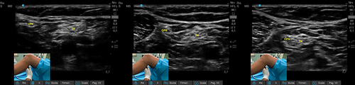 Figure 3 Traceback technique: moving from distal to proximal direction with the ultrasound transducer, both components of the sciatic nerve converge within the common paraneural sheath.