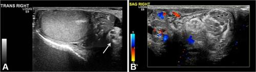Figure 2 Intermittent torsion in a 17-year-old boy who presented with 5 h of acute right testicular pain after a game of football. He had experienced 6–7 similar episodes in the last 2 years where the pain had spontaneously resolved. Cremasteric reflex was absent on the right. (A) Gray-scale transverse US image of the right testis shows a redundant spermatic cord (arrow) occupying the medial half of the scrotal sac, with a mildly edematous epididymis (E) adjacent to it. The echogenic mediastinum testis faced medially instead of posterolaterally, which was concerning for altered testicular lie. (B) Color Doppler longitudinal image of the right scrotum shows excess and tortuous spermatic cord bunched up in the scrotal sac superior to the testis and formation of a pseudomass, suggesting torsion of the spermatic cord. Note that this extratesticular pseudomass is not hyperemic and should not be confused with epididymitis. Orchiopexy was recommended; however, the family chose to wait because his pain had improved. Elective orchiopexy was performed 7 months later and bilateral bell clapper anomaly was noted; he was diagnosed with intermittent torsion. (Image obtained from Bandarkar AN, Blask AR. Testicular torsion with preserved flow: key sonographic features and value-added approach to diagnosis. Pediatr Radiol. 2018;48(5):735–744. doi:10.1007/s00247-018-4093-0.Citation27 Distributed under the terms of the Creative Commons Attribution 4.0 International License (http://creativecommons.org/licenses/by/4.0/). No changes have been made to the images or the image description).
