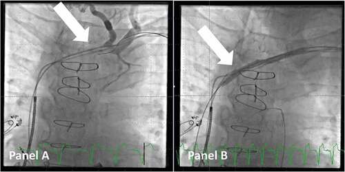 Figure 2. Venoplasty of a stenotic access to the superior caval vein. Panel A: venogram shows a stenotic part (arrow) of the venous access to the superior caval vein in a patient scheduled for upgrade to CRT. Panel B: A balloon (arrow) is used for venoplasty of the stenotic and fibrotic part of the venous system to gain access. Note that a guidewire is now in the right ventricular outflow tract.
