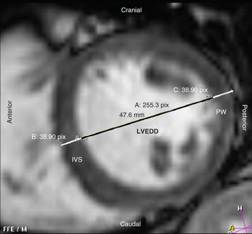 Figure 1. Measurements on short-axis magnetic resonance images were placed to correspond with measurements made on M-mode echocardiography and were used to calculate the left ventricular mass with the formula commonly used in echocardiography (LVMMRI/ASE). The end-diastolic inner left ventricular diameter (LVEDD) was measured from the middle of the inner aspect of the septal wall to the inner aspect of the posterior wall, and the interventricular septal thickness (IVS) and the posterior wall thickness (PW) were measured at the same level. To correspond with a parasternal short-axis M-mode view the image has to be turned 90 degrees clockwise.