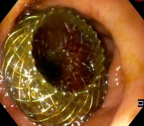 Figure 4 Endoscopic image obtained after electrocautery lumen-apposing metal stent (EC-LAMS) deployment in the gastric lumen.