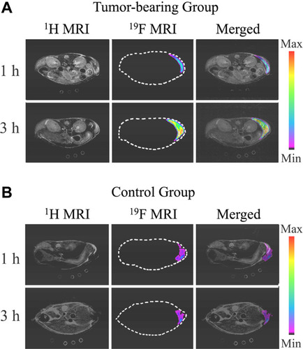 Figure 5 In vivo 1H, 19F MRI, and merged images of 1H and 19F MRI for (A) a tumor-bearing mouse and (B) a healthy mouse. Adapted from Guo C, Zhang Y, Li Y et al 19F MRI nanoprobes for the turn-on detection of phospholipase A2 with a low background. Anal. Chem. 2019;91(13):8147–8153. Copyright © 2019 American Chemical Society.Citation160