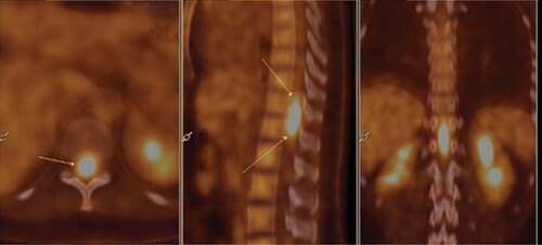 Figure 2. Atypical spinal cord lymphoma infiltration. Transversal and sagittal slides from PET showing intramedullary signal in front of T10 to L1 vertebrae. The arrows show a hypermetabolic lesion located in the spinal cord.
