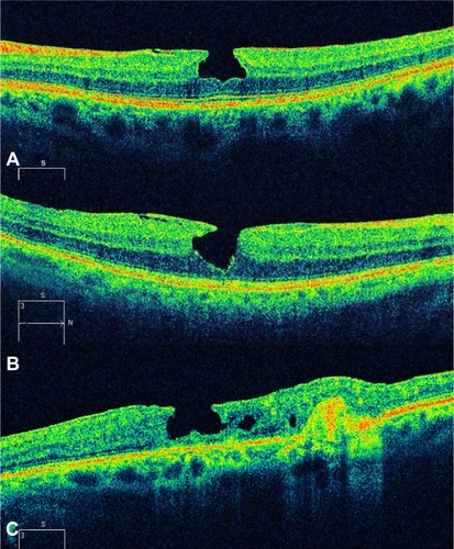 Figure 12 Spectral domain optical coherence tomography images of a 63-year-old male.