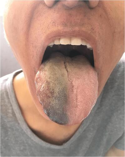 Figure 2 Swelling tongue with anterior ischemic lingual necrosis in a patient with giant cell arteritis.