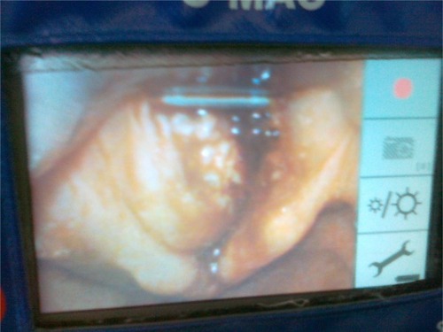 Figure 2 Case 1: laryngoscopy was performed with the C-MAC videolaryngoscope.