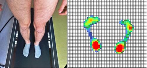 Figure 2 Disposure the feet in static position – Diers pedoscan.