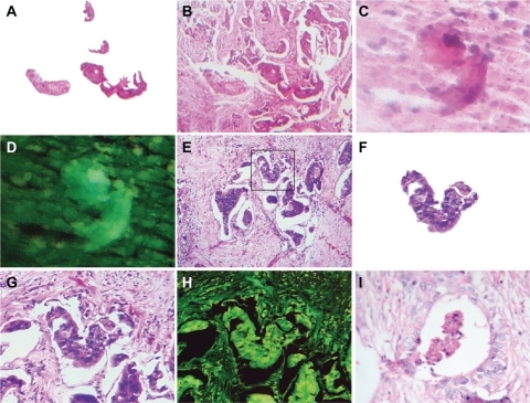 Figure 5 High-gradient self-assembled sequential embryoid body pattern formation. A is a detachment subimage of B, which shows high-gradient sequential embryoid body pattern formation from a case of breast adenocarcinoma, hematoxylin and eosin staining (20×); C shows a sequential embryoid body pattern with well-defined formation from a necrotic area in an undifferentiated sarcoma tissue, hematoxylin and eosin staining (20×); D is a negative image of C; E–G are closeup views of a well-defined embryoid body pattern formation in a case of breast adenocarcinoma, hematoxylin and eosin staining (20×); H is a negative image of G; I shows a well-defined pattern of embryoid body formation in a case of prostate adenocarcinoma, hematoxylin and eosin staining (20×).