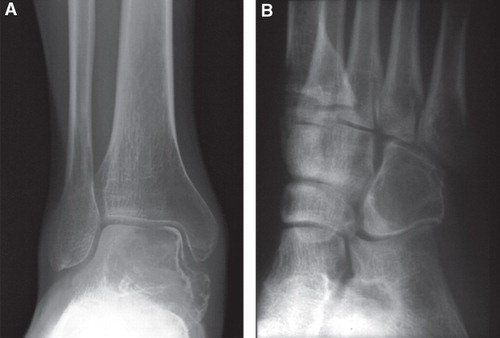 Figure 2. Radiograph of GCT involving the talus (A) and cuboid (B). As in Figure 1, both lesions are purely lytic with partially sclerotic rim, although the expansion of bone is not prominent. The lesions appear eccentric.