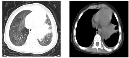 Figure 2 CT imaging findings of severe cases.