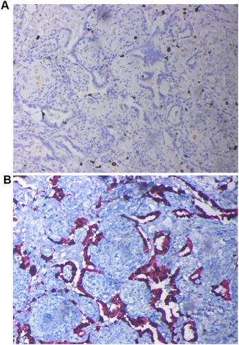 Figure 4 Immunohistochemical staining (20-X) revealed Ki61 positivity (A), cytokeratin 7 (CK7) and thyroid transcription factor-1 (TTF-1) positivity (B).