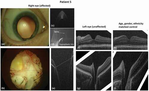 Figure 6. Anterior (A) and posterior (B) segment photography and OCT (C–J) of a patient with right iris and optic nerve coloboma (A–G) and of the healthy control (H, I). Anterior segment photography (A) shows iris coloboma at 6 o’clock with visible zonula fibers of the lens; fundus photograph (B) demonstrates right optic nerve coloboma without clearly defined optic disc margins, and the fovea was not identified. Dotted lines in figures B and E display the corresponding area of the coloboma on fundus photography and OCT. On OCT, the optic nerve has a large excavation; the fovea was not seen. Figure C shows a normal cornea in the affected eye; figure D shows the anterior tomogram in the area of the coloboma with a flat hypoplastic iris stump. The fovea in the unaffected side (F) had a wider and larger foveal pit as compared to the healthy control (H). Tomograms of the optic nerve in the unaffected side (G) and healthy control (I) appeared similar. Reprinted with permission from [Citation63], licensed under https://creativecommons.org/licenses/by/4.0/.